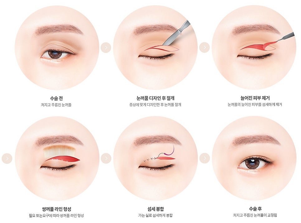 강남눈성형외과 잘하는 곳 구분하는 방법 3가지, 전문의가 알려드림 관련 이미지 6