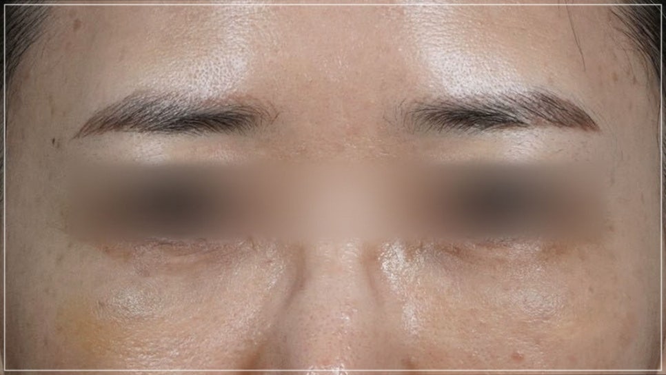 Conditions for Under-Eye Fat Repositioning in Gangnam That Lasts Long, Is Safe, and Allows a Quick Return to Daily Life image 23