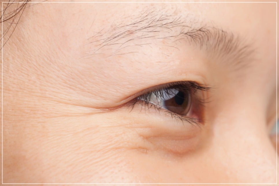 Eye Thermage and Eye Ulthera: Treatment Areas and Effects, a Dermatology Director's Honest Opinion image 7