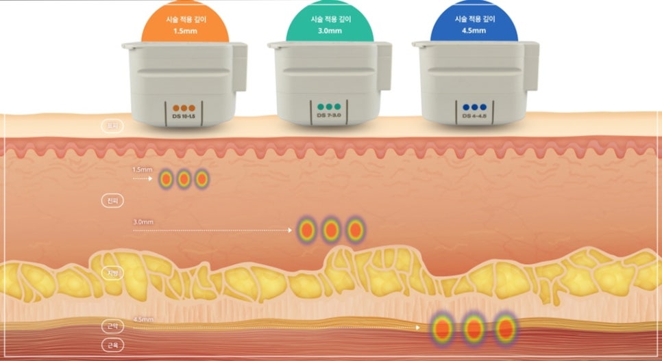 Criteria a Gangnam Station Ultherapy Dermatology Director Chooses When She Is the Patient (+Price Event) image 6