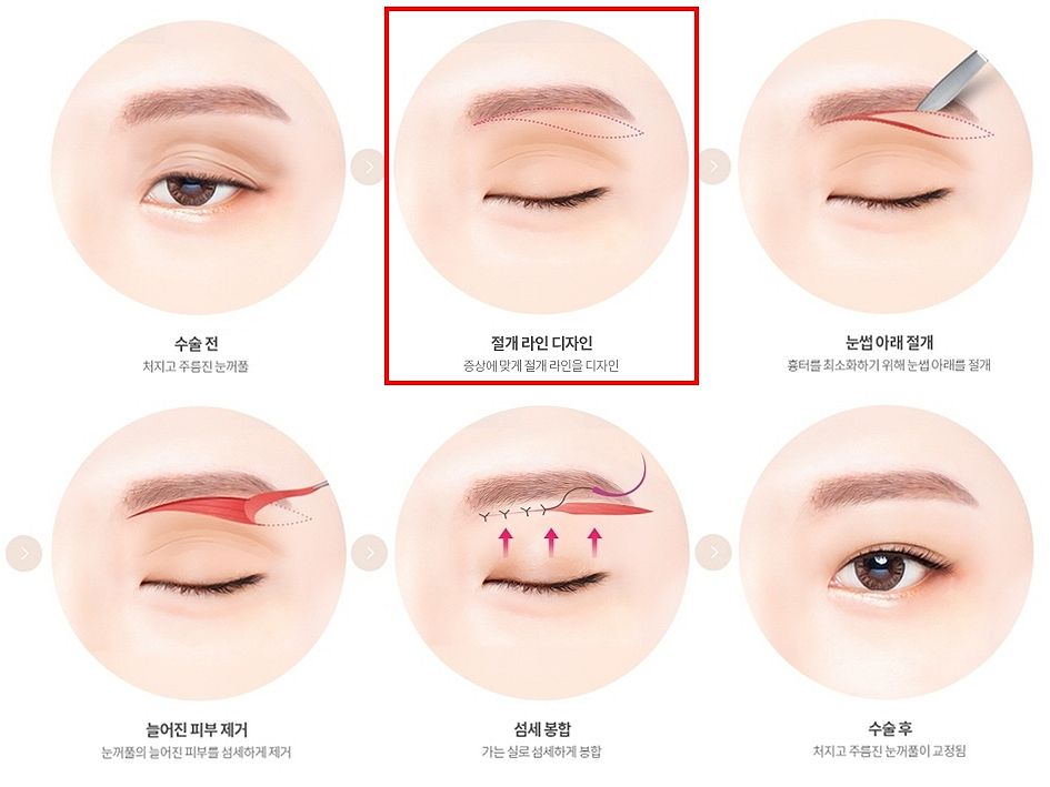 Midlife Eyelid Sagging Surgery: Which Cases Are Suitable for Upper Blepharoplasty or Brow Lift, Scars, Recovery Time — This Article Answers It All image 14
