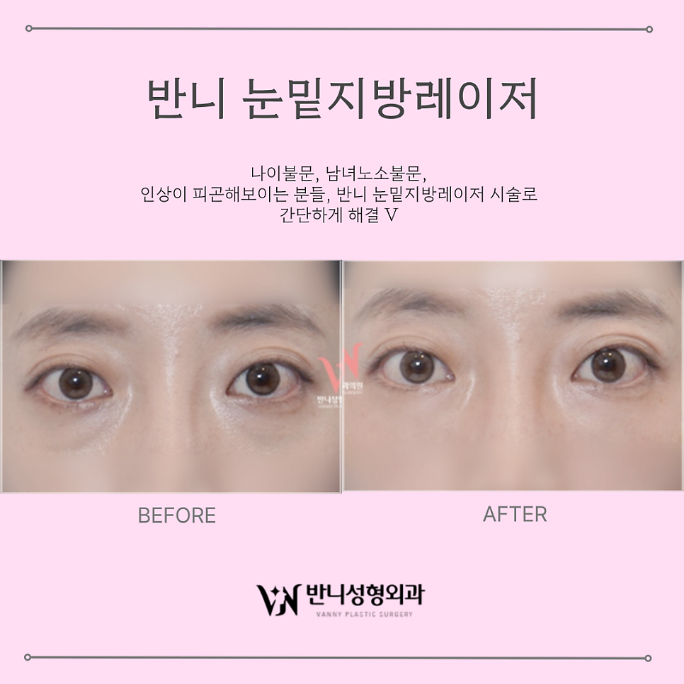 Under-Eye Fat Laser Treatment: Brightening the Eye Area Without the Burden image 5