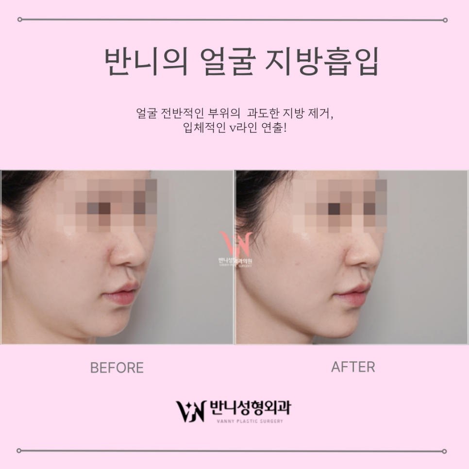 Face Liposuction Review: How to Enhance Your Contours Naturally image 6