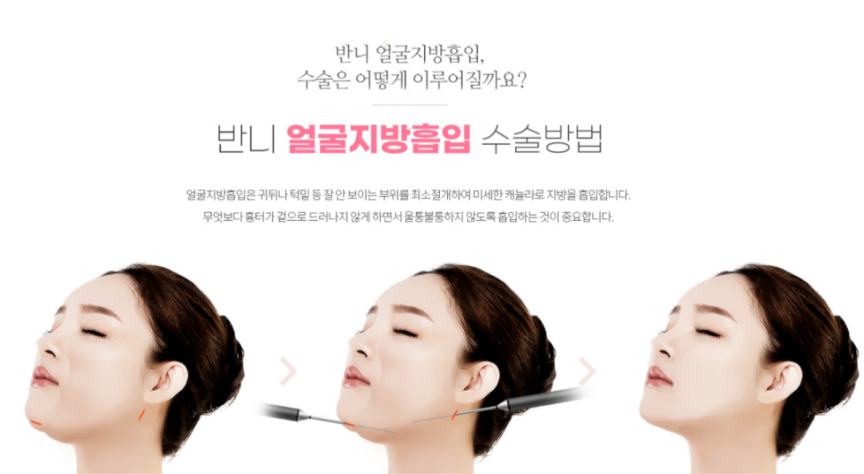 Face Liposuction Review: How to Enhance Your Contours Naturally image 7