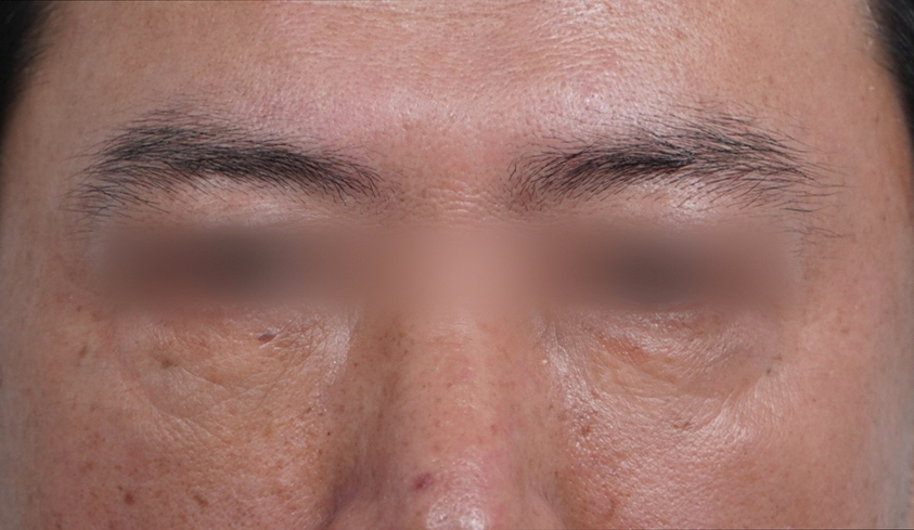 눈밑지방재배치 다크서클 해결 가능? 성형외과 전문의의 솔직 의견 관련 이미지 14