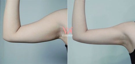 강남 온다 리프팅 망하는 가장 흔한 이유, 온다 리프팅 문의 하루 30건 받는 강남 피부과 원장이 솔직하게 말씀드립니다. 관련 이미지 29