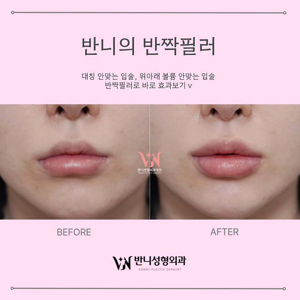 Natural Lip Filler: Achieving Volume and Harmony at the Same Time image 5