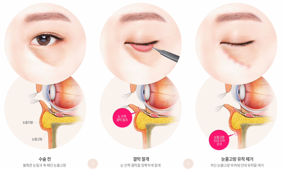 The One Critical Question to Avoid Revision Under-Eye Fat Repositioning (+Causes of Recurrence) image 5