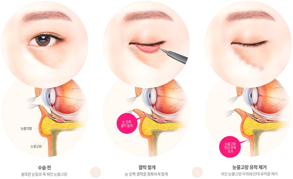 눈밑지방재배치 다크서클 해결 가능? 성형외과 전문의의 솔직 의견 관련 이미지 22