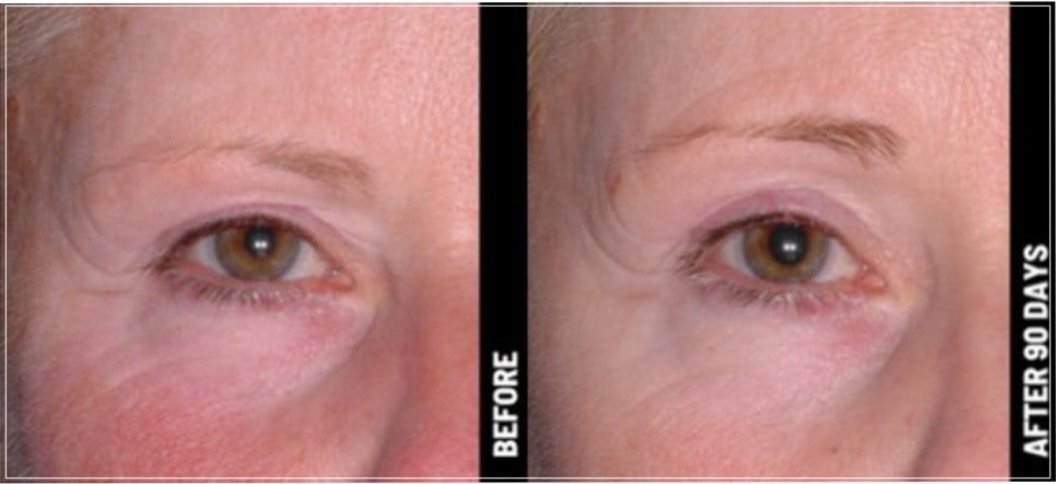 Eye Thermage and Eye Ulthera: Treatment Areas and Effects, a Dermatology Director's Honest Opinion image 16
