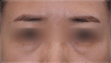 Conditions for Under-Eye Fat Repositioning in Gangnam That Lasts Long, Is Safe, and Allows a Quick Return to Daily Life image 24