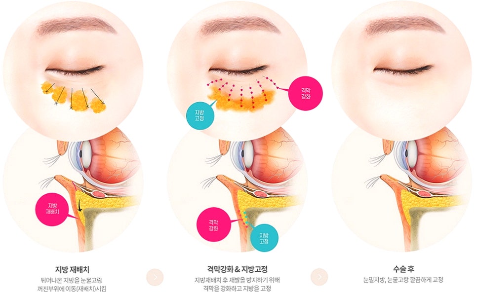 눈밑지방재배치 다크서클 해결 가능? 성형외과 전문의의 솔직 의견 관련 이미지 23