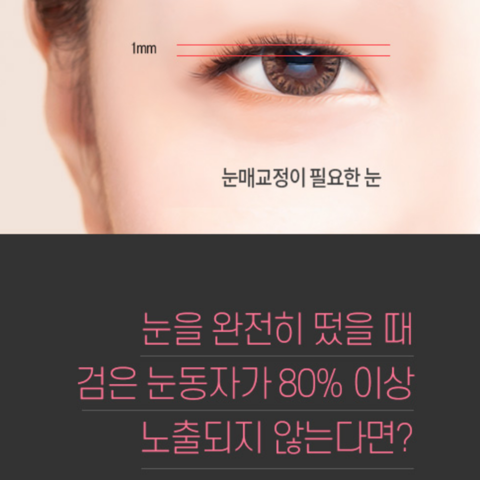 Before and After Ptosis Correction: How to Create a Clear and Natural Change image 2