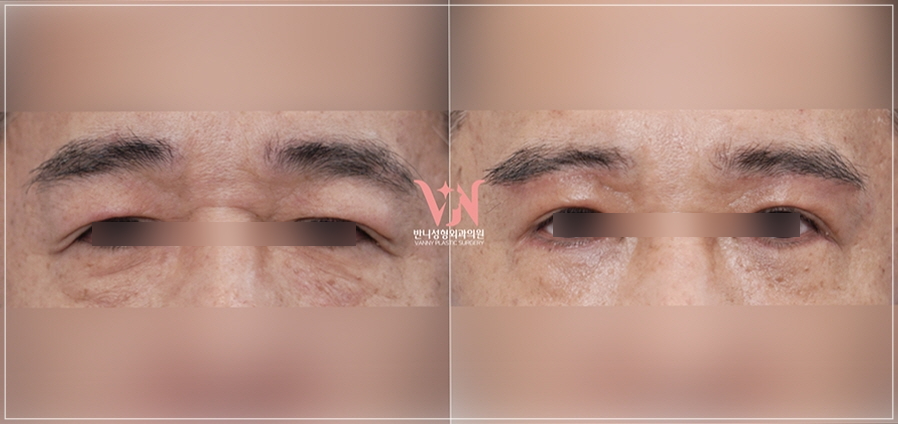 The One Critical Question to Avoid Revision Under-Eye Fat Repositioning (+Causes of Recurrence) image 3