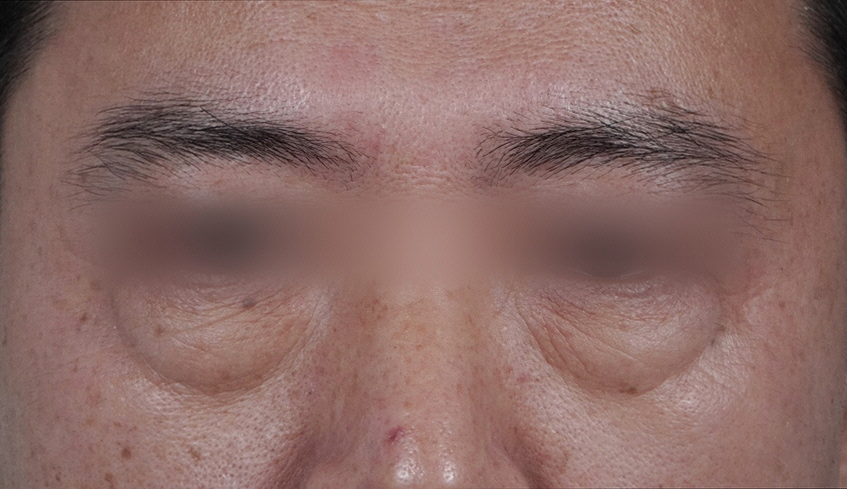 눈밑지방재배치 다크서클 해결 가능? 성형외과 전문의의 솔직 의견 관련 이미지 13