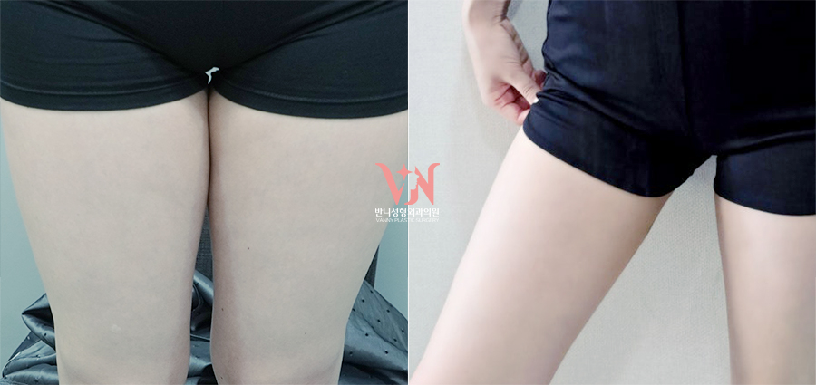 강남 온다 리프팅 망하는 가장 흔한 이유, 온다 리프팅 문의 하루 30건 받는 강남 피부과 원장이 솔직하게 말씀드립니다. 관련 이미지 30