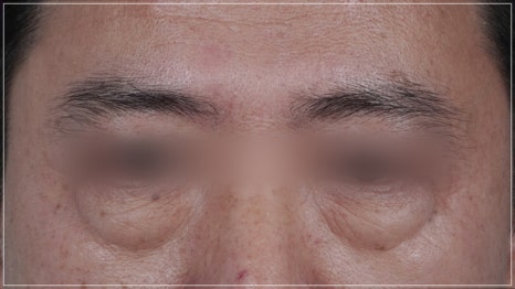 강남눈성형외과 잘하는 곳 구분하는 방법 3가지, 전문의가 알려드림 관련 이미지 10