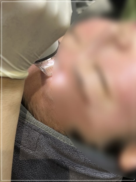 포텐자 여드름, 흉터 자국까지 하나로 올킬 가능한 이유 (+펌핑팁 효과) 관련 이미지 24