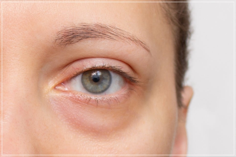 A Doctor with 20,000 Clinical Cases Shares How to Find the Best Under-Eye Filler Clinic in Gangnam image 8