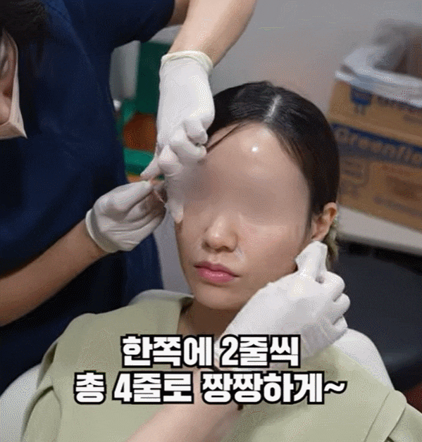 The Best Place for Thread Lifting for Nasolabial Folds in Gangnam Improves Both Hollowness and Sagging. image 8