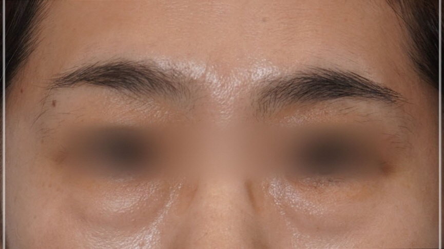 The One Critical Question to Avoid Revision Under-Eye Fat Repositioning (+Causes of Recurrence) image 7