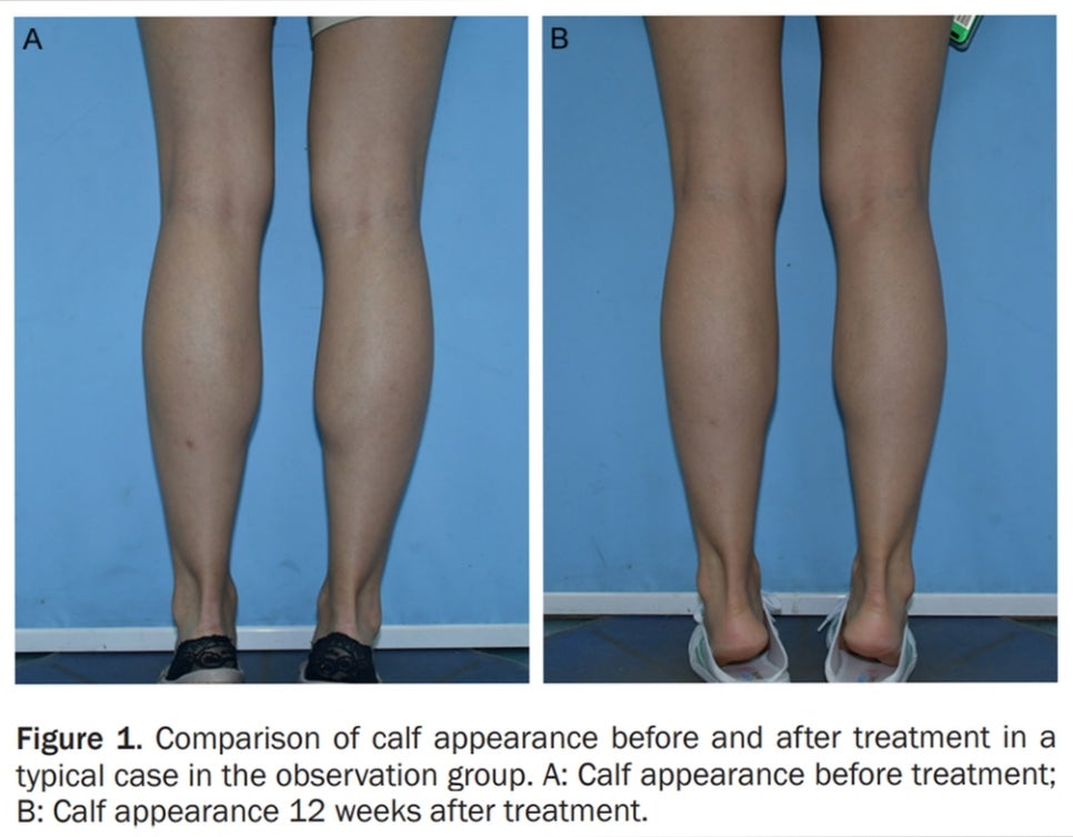 What Is a Dermatology Clinic That Does Great Calf and Trapezius Botox, Hyperhidrosis Botox, and Fat-Dissolving Injections for Body Care in Gangnam? (+Event) image 5