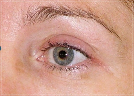 Eye Thermage and Eye Ulthera: Treatment Areas and Effects, a Dermatology Director's Honest Opinion image 11