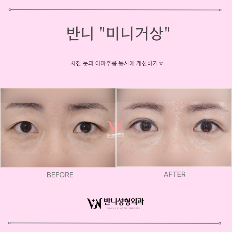 Forehead Lift Before and After: If You Want a Safer and More Effective Method image 3