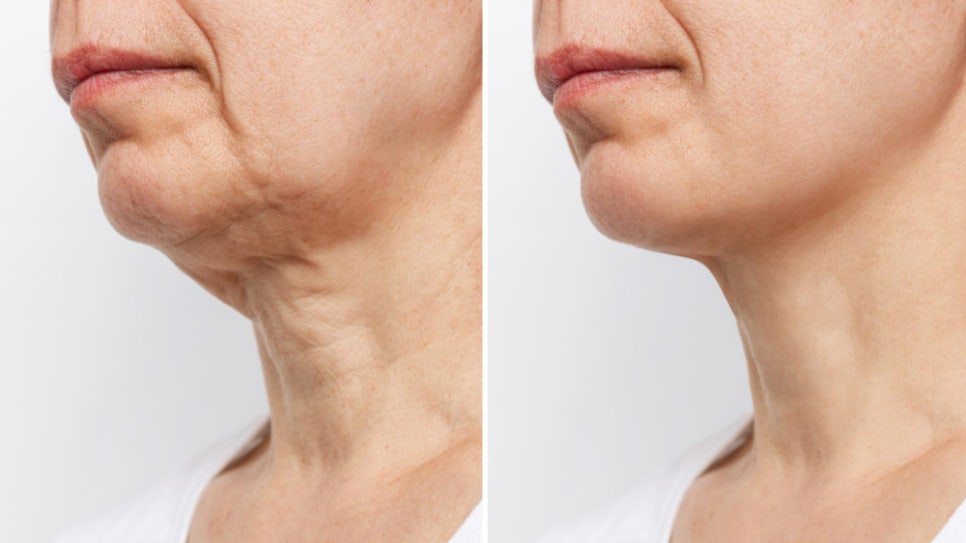 If your face is like this, "buccal fat removal" is not the first step — Gangnam "buccal fat lifting" is. image 13