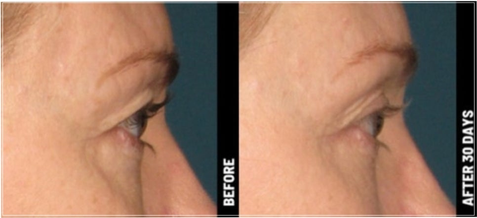 Eye Thermage and Eye Ulthera: Treatment Areas and Effects, a Dermatology Director's Honest Opinion image 18
