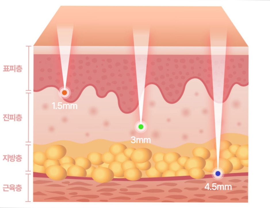 Ultherapy Effectiveness: Fact Check for Thin Faces O, Filling Sunken Areas X (+ Gangnam Event Dermatology Clinic) image 8