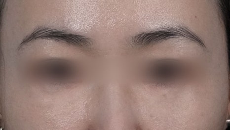 Under-Eye Fat Repositioning Recovery Period: Just Two Days! A Plastic Surgeon Reveals the Conditions for a Quick Return to Daily Life image 5
