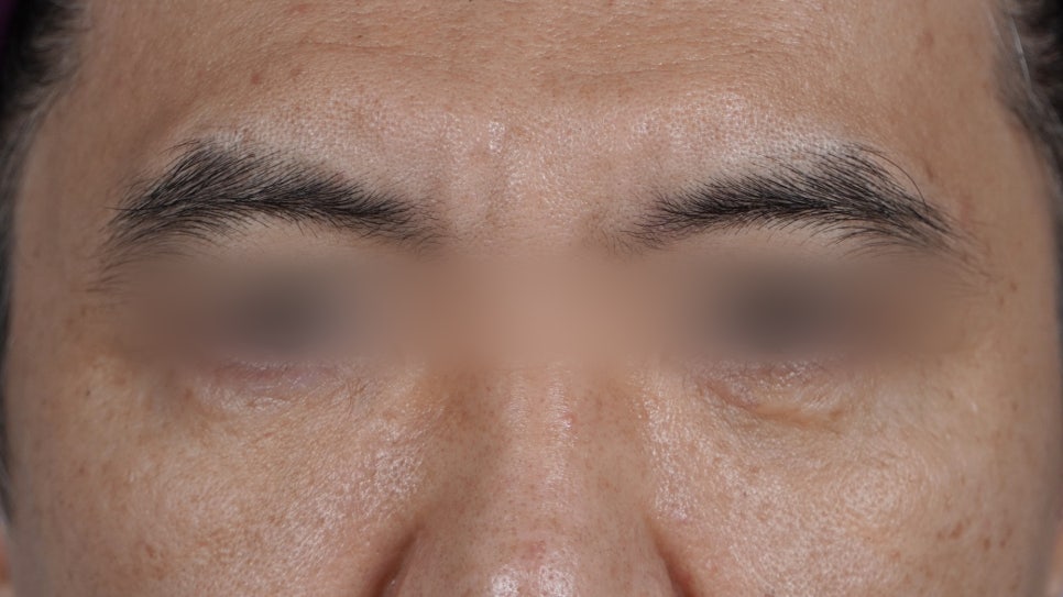 Under-Eye Fat Repositioning Recovery Period: Just Two Days! A Plastic Surgeon Reveals the Conditions for a Quick Return to Daily Life image 10