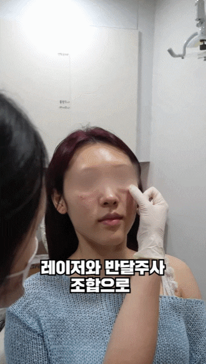 눈밑지방재배치 시술 효과, 통증, 붓기, 후 관리까지 이 글로 종결 관련 이미지 10