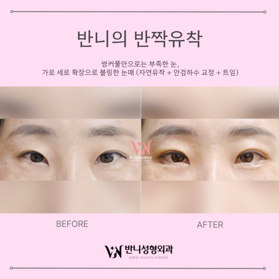 연예인 뒷트임 자연스럽게 눈매를 확장하는 방법 관련 이미지 3