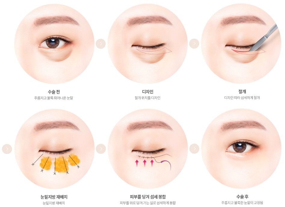 Honest Advice from a Plastic Surgeon on Finding a Good Clinic for Middle-Aged Eye Surgery image 8