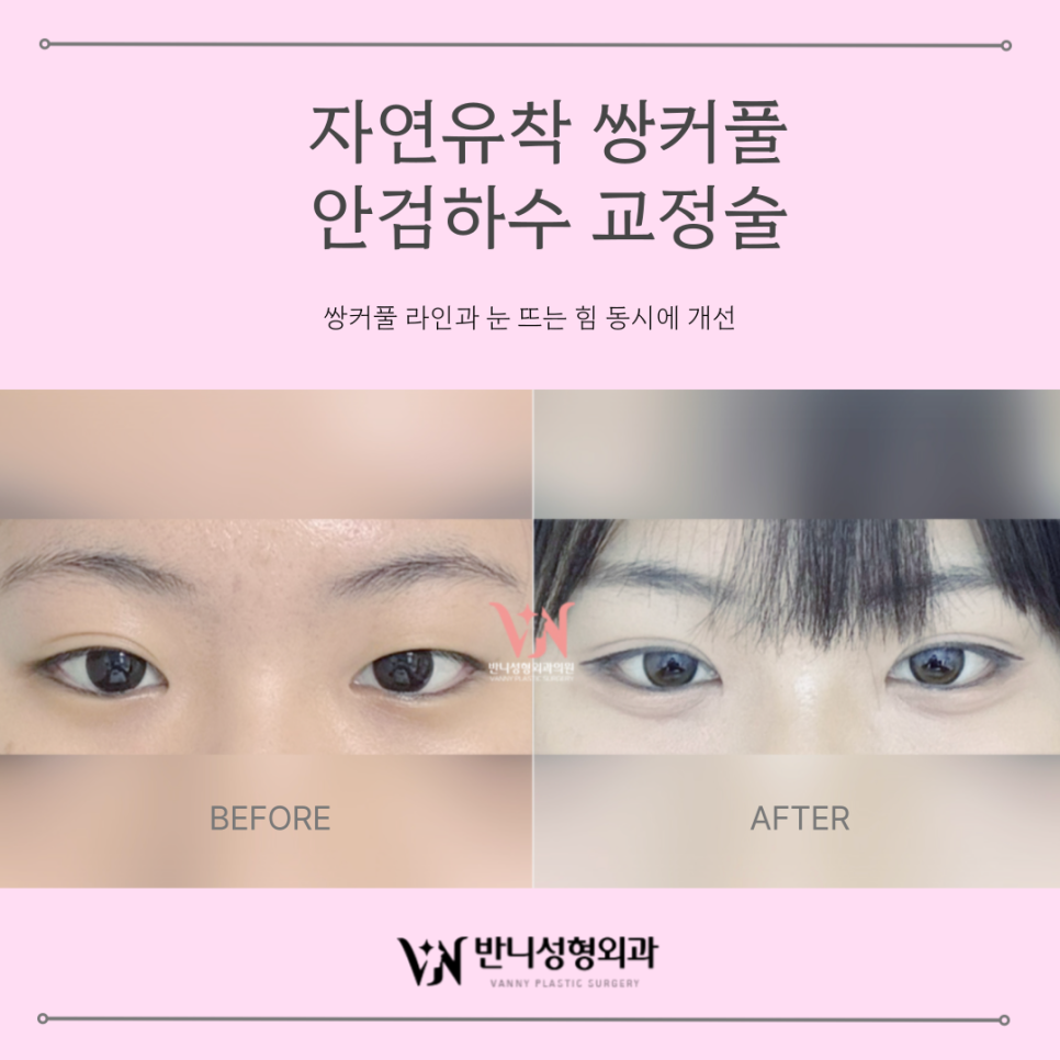 쌍커풀 윗트임 답답한 눈매를 시원하게 여는 방법 관련 이미지 4