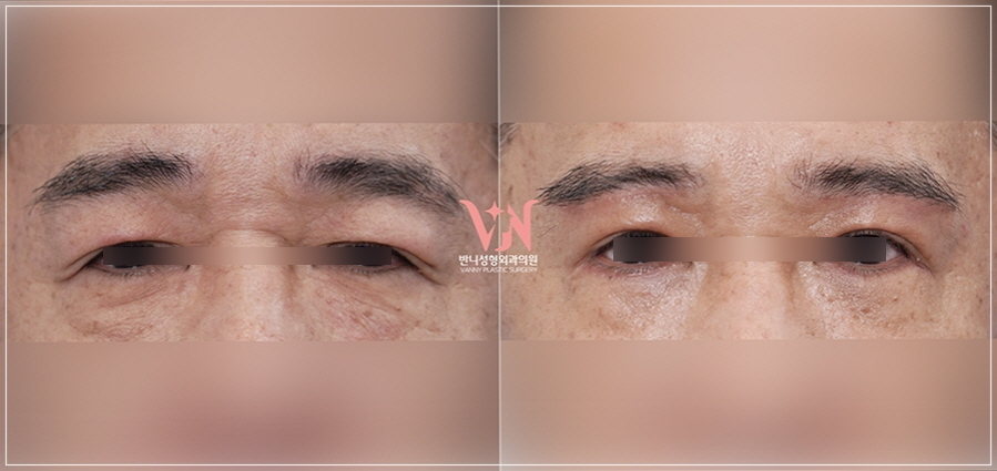Midlife Eyelid Sagging Surgery: Which Cases Are Suitable for Upper Blepharoplasty or Brow Lift, Scars, Recovery Time — This Article Answers It All image 5