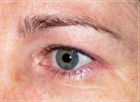 Eye Thermage and Eye Ulthera: Treatment Areas and Effects, a Dermatology Director's Honest Opinion image 10