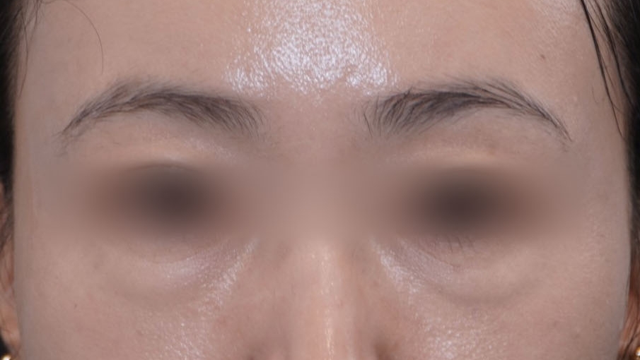 Under-Eye Fat Repositioning Recovery Period: Just Two Days! A Plastic Surgeon Reveals the Conditions for a Quick Return to Daily Life image 2