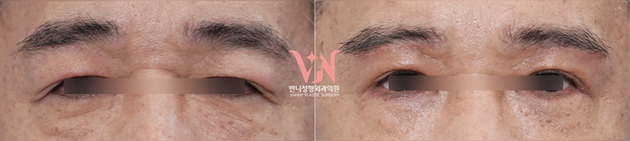 Conditions for Under-Eye Fat Repositioning in Gangnam That Lasts Long, Is Safe, and Allows a Quick Return to Daily Life image 14