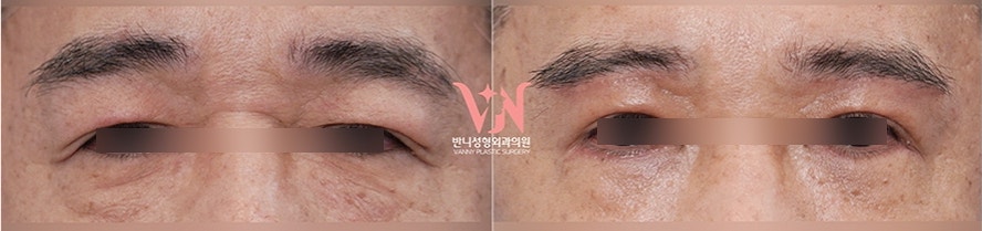 Honest Advice from a Plastic Surgeon on Finding a Good Clinic for Middle-Aged Eye Surgery image 4