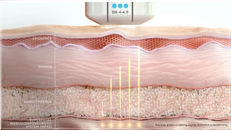 Ultherapy Effectiveness: Fact Check for Thin Faces O, Filling Sunken Areas X (+ Gangnam Event Dermatology Clinic) image 6