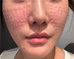 Gangnam Re2O Treatment: Controversy Over Use of Human Tissue and Side Effects? Misconceptions and Facts About Re2O. image 26