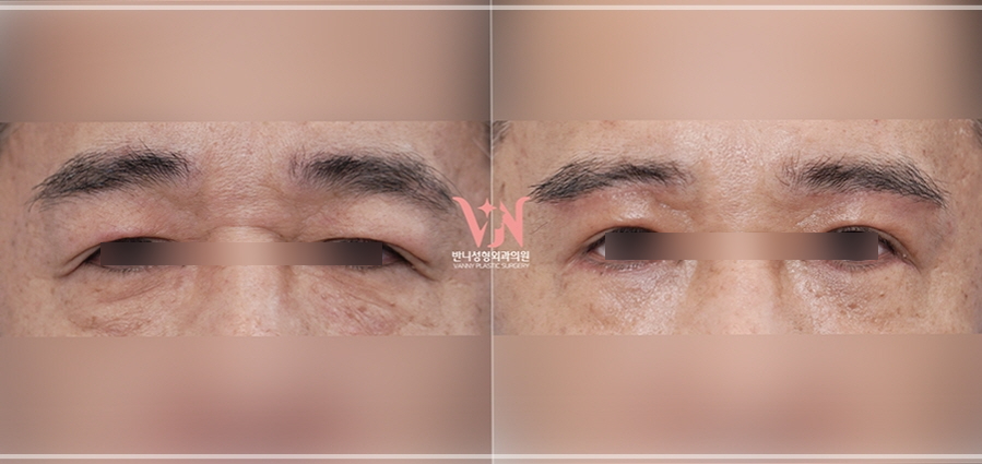 강남 하안검수술 잘하는 병원 가릴 수 있는 3가지 질문(부작용) 관련 이미지 4