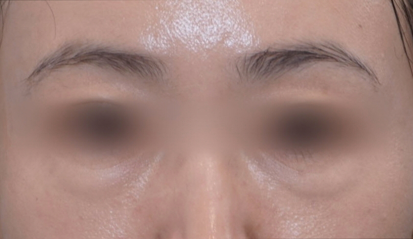눈밑지방재배치 다크서클 해결 가능? 성형외과 전문의의 솔직 의견 관련 이미지 4