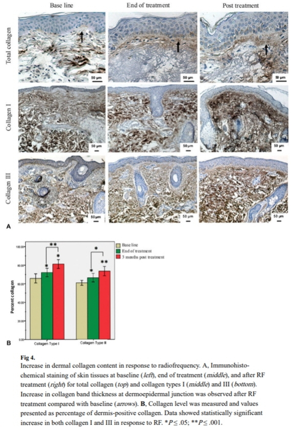 Thermage Effect Timing, Duration, and Treatment Interval: A Dermatology Director in Gangnam Shares an Honest View image 11