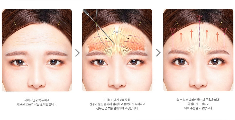 A Case Where Upper Blepharoplasty in Gangnam Won’t Help, a Plastic Surgeon’s Honest Opinion image 17