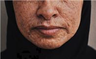 Gangnam Re2O Treatment: Controversy Over Use of Human Tissue and Side Effects? Misconceptions and Facts About Re2O. image 31