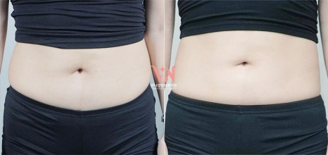 강남 온다 리프팅 망하는 가장 흔한 이유, 온다 리프팅 문의 하루 30건 받는 강남 피부과 원장이 솔직하게 말씀드립니다. 관련 이미지 28